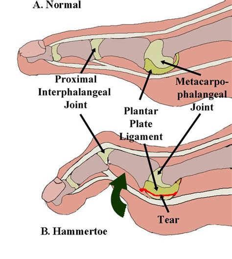 Plantar plate tear icd 10 - ICD 10 code for Unspecified injury of plantar artery of unspecified foot, initial encounter. Get free rules, notes, crosswalks, synonyms, history for ICD-10 code S95.109A. ... ICD-10-CM S95.109A is grouped within Diagnostic Related Group(s) (MS-DRG v 41.0): 913 Traumatic injury with mcc;